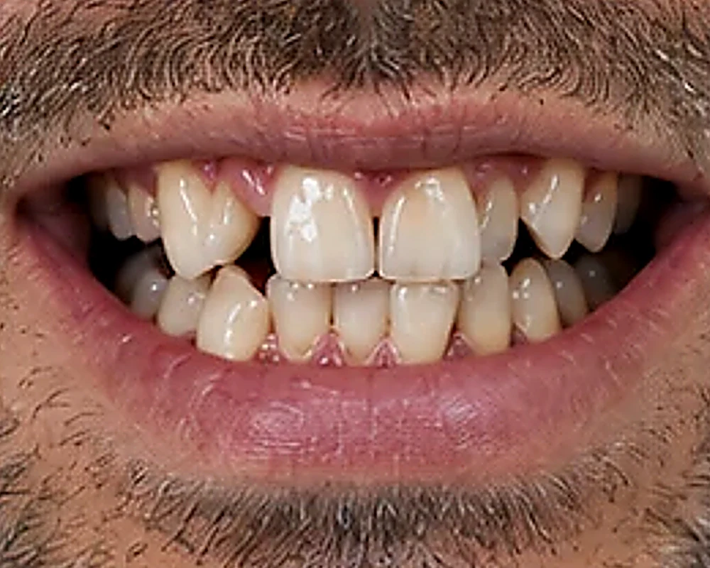 Ortodoncia: antes del tratamiento (imagen ilustrativa)